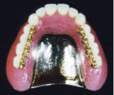 ハイグレード金属床義歯（総入れ歯）