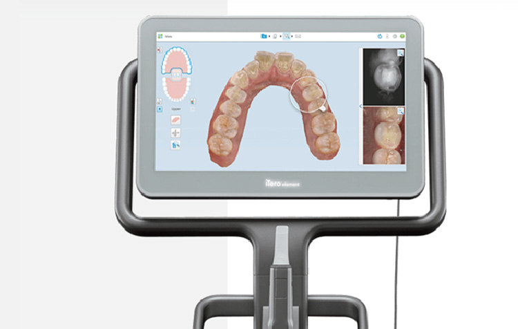 デジタル光学スキャナー「iTeroeremennto 5D」iTeroエレメント5D 