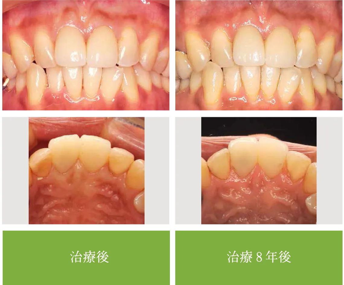 after 治療後 治療8年後