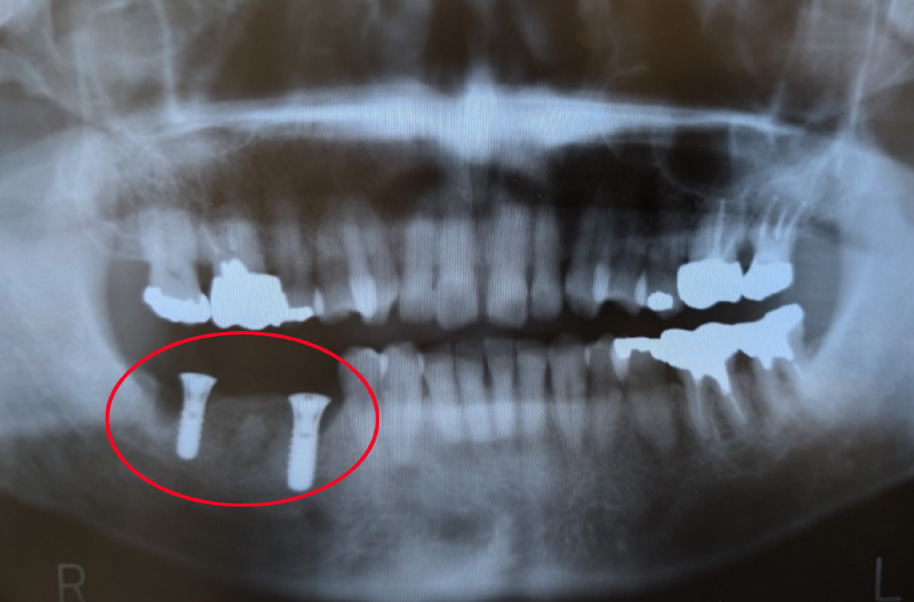 インプラント症例 埋入直後
