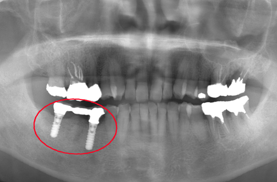 インプラント症例 16年後