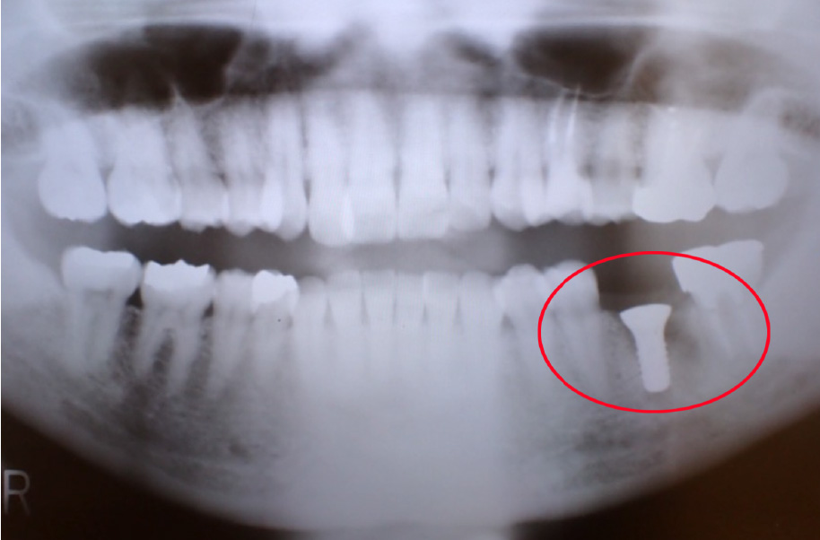 インプラント症例 埋入直後