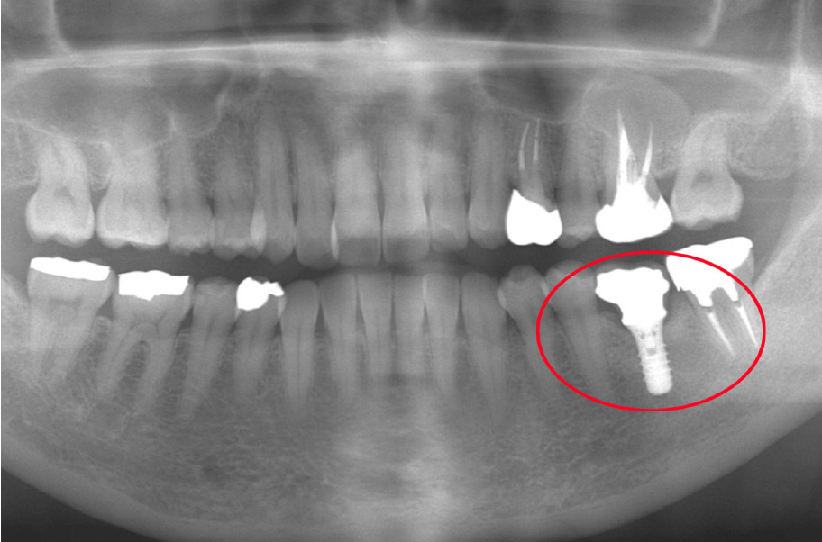 インプラント症例 16年後
