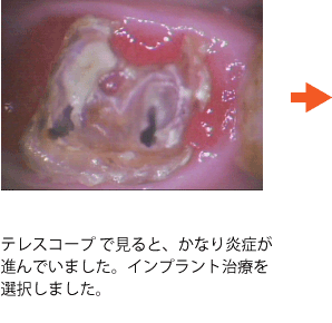 インプラント症例