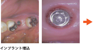 インプラント症例