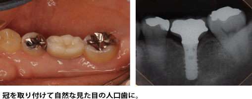 インプラント症例