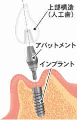 インプラント