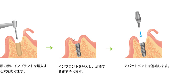 インプラント