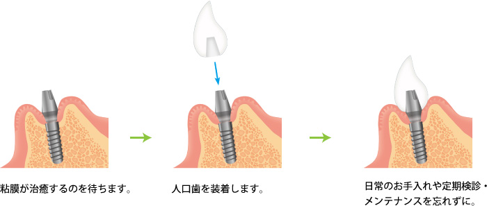 インプラント