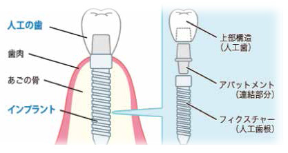 インプラント
