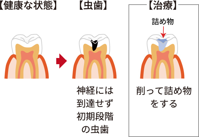 虫歯の進行状態 健康な状態→虫歯