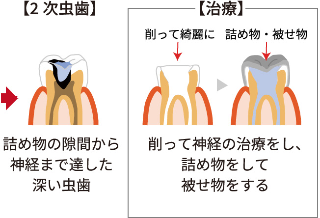 2次虫歯 治療