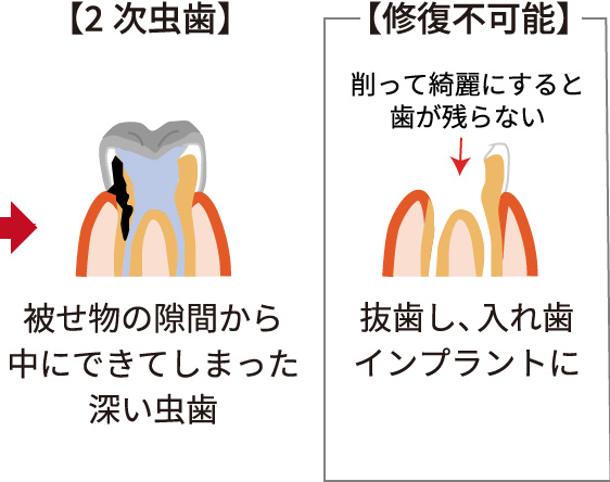2次虫歯 修復不可能