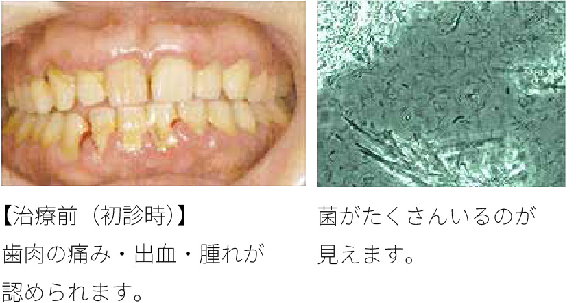 歯周病菌検査（顕微鏡）
