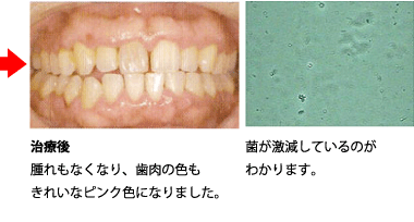 歯周病菌検査（顕微鏡）