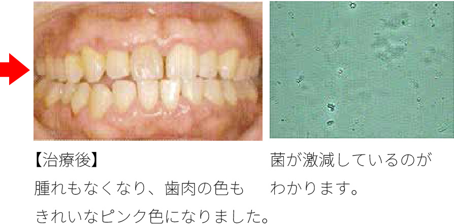 歯周病菌検査（顕微鏡）