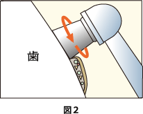 歯のクリーニングについて図2