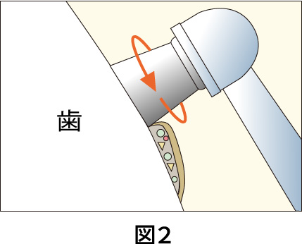 歯のクリーニングについて図2