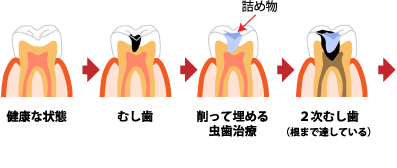 虫歯の進行状態