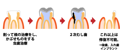 虫歯の進行状態