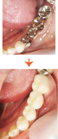 セラミックブリッジ(咬合面メタル) 