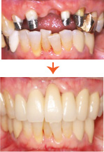 セラミックブリッジ(前歯) 