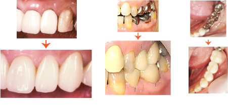 被せものオールセラミック