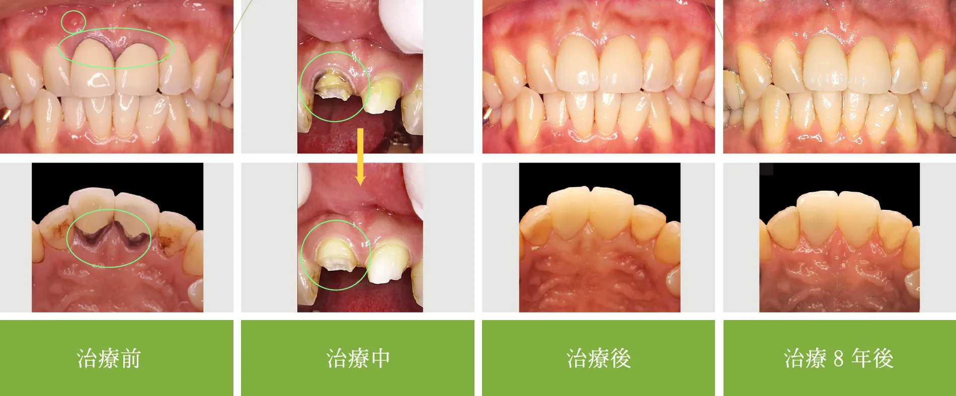 審美治療 症例1 CASE 1 前歯を綺麗に