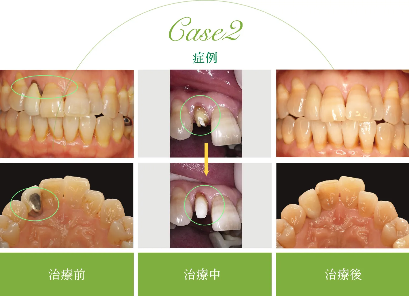 審美治療 症例2 CASE 2