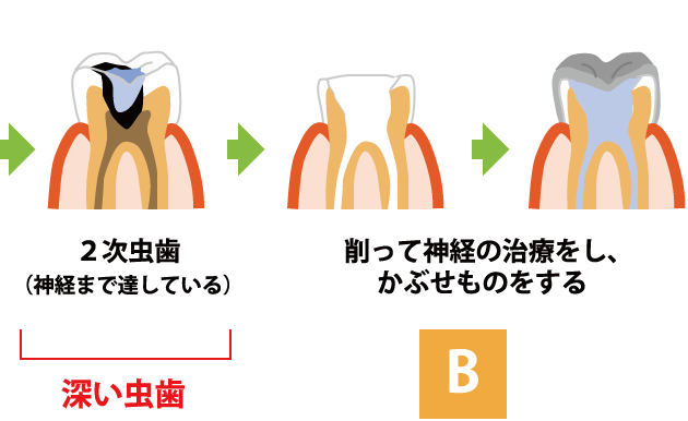 虫歯の進行B 深い虫歯 被せもの