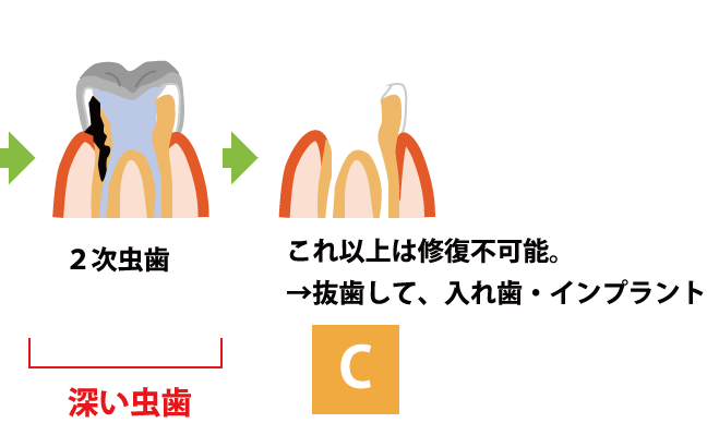 虫歯の進行C 修復不可能 抜歯