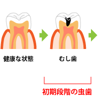 虫歯の進行A 初期段階
