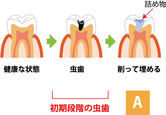 虫歯の進行A 初期段階