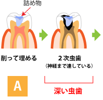 虫歯の進行A 初期段階