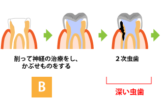 虫歯の進行B 深い虫歯 被せもの