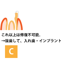 虫歯の進行C 修復不可能 抜歯