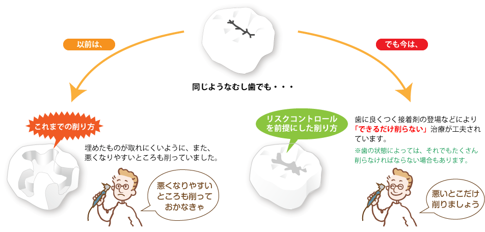虫歯の初期段階の治療