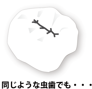 同じような虫歯でも