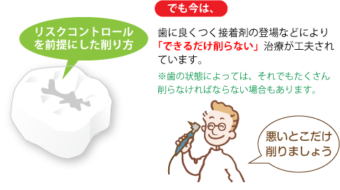 虫歯の初期段階の治療 現在 できるだけ削らない治療