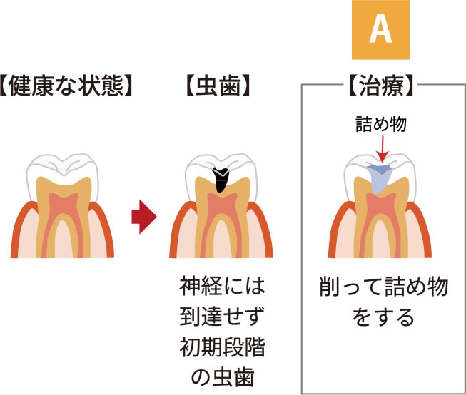 虫歯の進行状態 健康な状態→虫歯