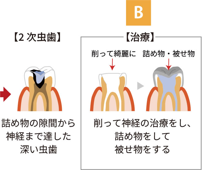 2次虫歯 治療
