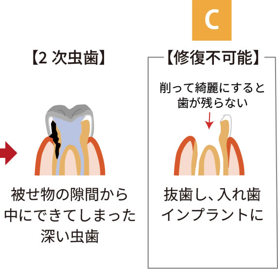 2次虫歯 修復不可能