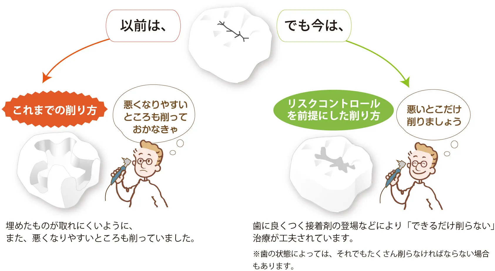 虫歯の治療 以前：悪くなりやすいところも削っていました。 現在：できるだけ削らない治療。