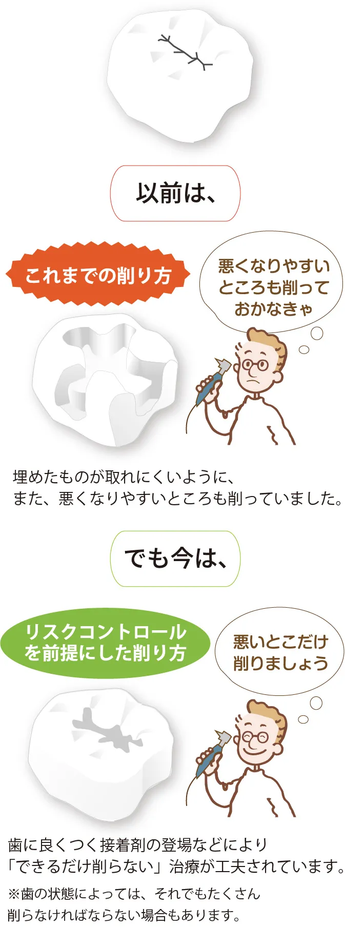 虫歯の治療 以前：悪くなりやすいところも削っていました。 現在：できるだけ削らない治療。