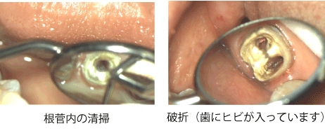 歯の根管内の清掃,破折（歯にヒビが入っています）