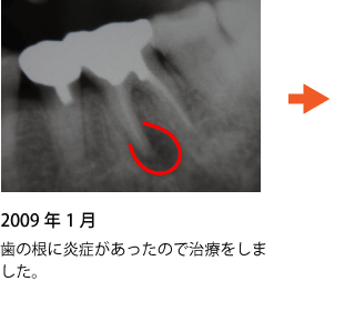 歯の神経の治療 症例