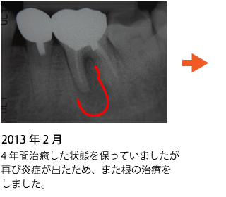 歯の神経の治療 症例