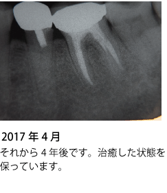 歯の神経の治療 症例