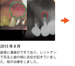 歯の神経の治療 症例