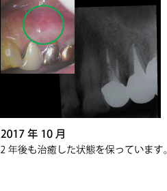 歯の神経の治療 症例